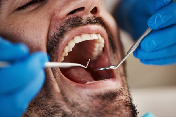 Best Emergency Wisdom Tooth Extraction in Cozad, NE